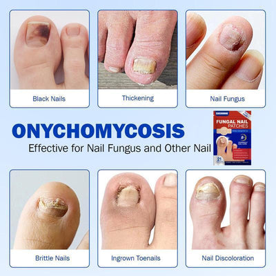 ToeVive Fungal Nail Patches